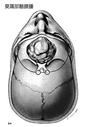 嗅窩部髄膜の図-2