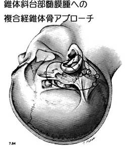 錐体斜台部髄膜-2